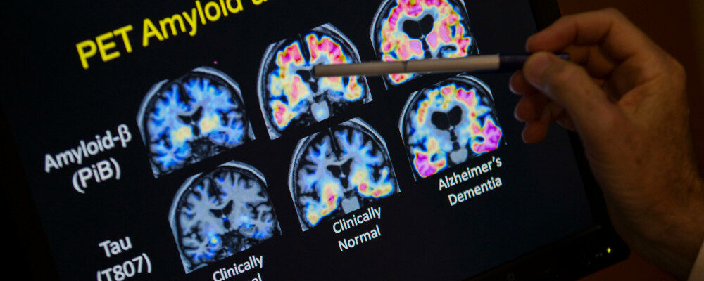 In this May 19, 2015, file photo, a doctor points to PET scan results that are part of a study on Alzheimer's disease at a hospital in Washington. Evan Vucci/AP Photo.