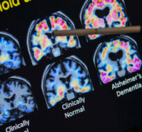 In this May 19, 2015, file photo, a doctor points to PET scan results that are part of a study on Alzheimer's disease at a hospital in Washington. Evan Vucci/AP Photo.